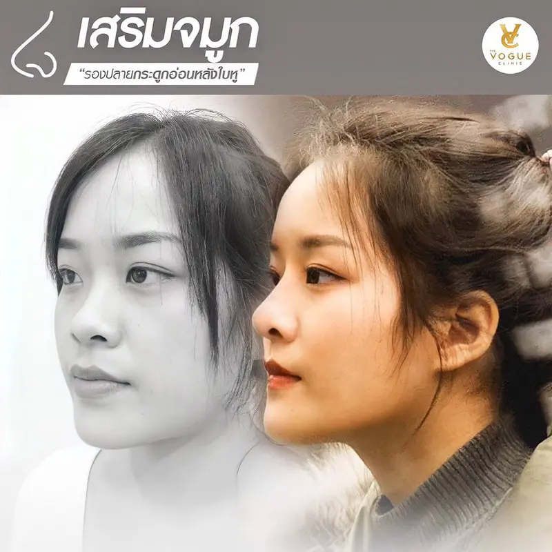 เสริมจมูกรองปลายหลังหู