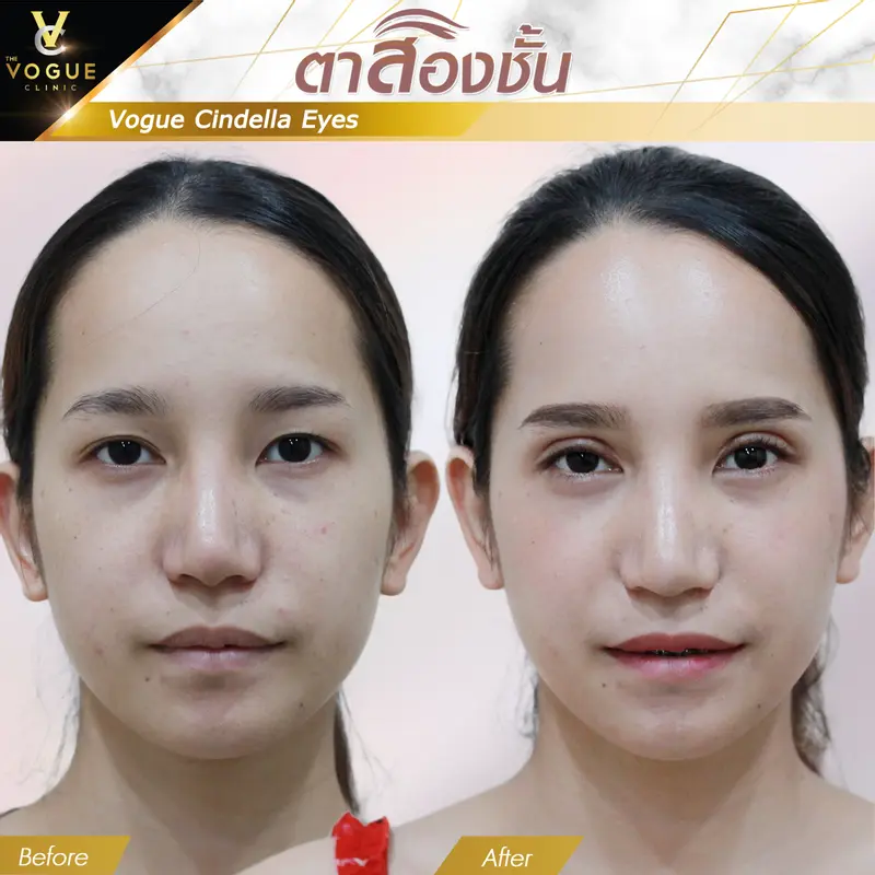 แก้หนังตาตก ชลบุรี