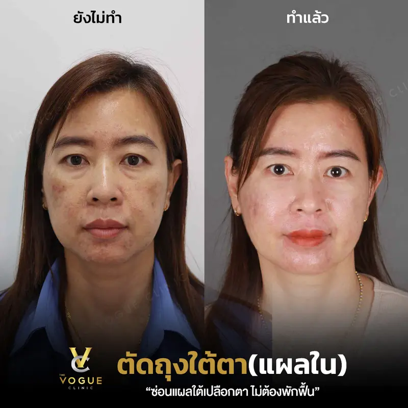 ตัดถุงใต้ตา
