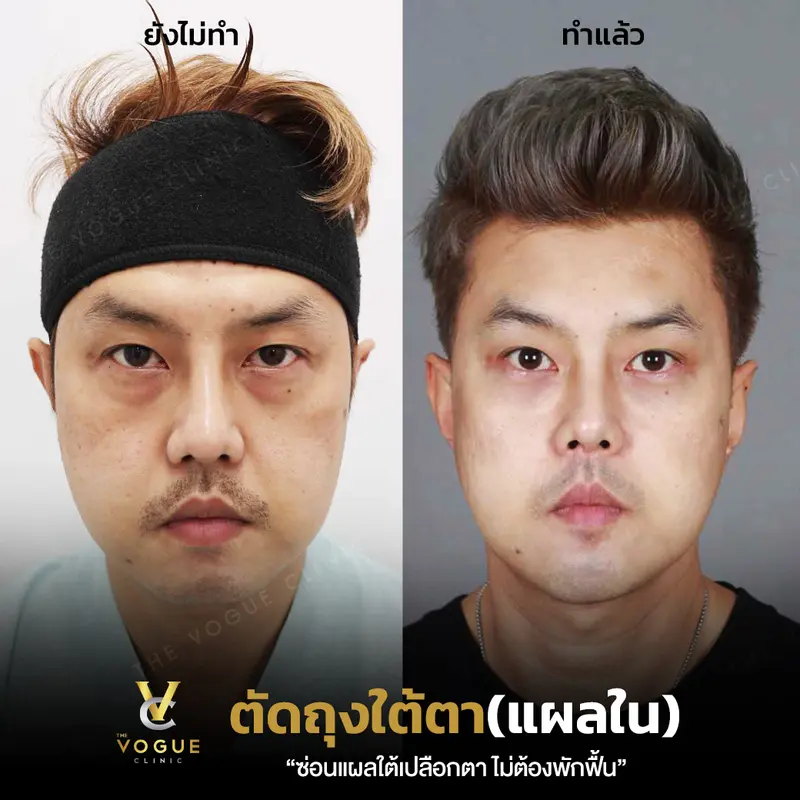 ตัดถุงใต้ตา
