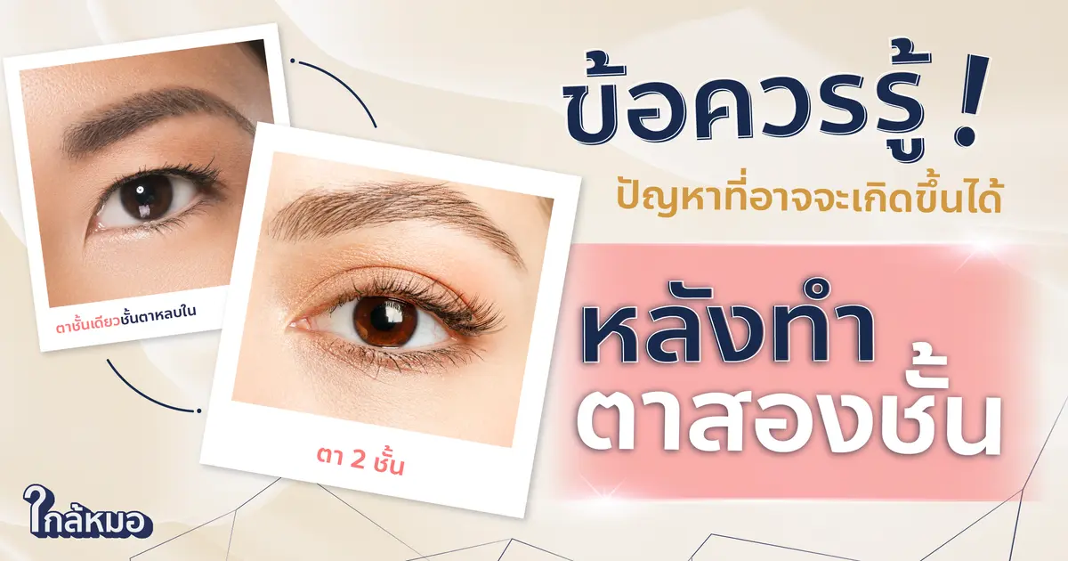 ข้อควรรู้ ! ปัญหาที่อาจจะเกิดขึ้นได้หลังทำตาสองชั้น