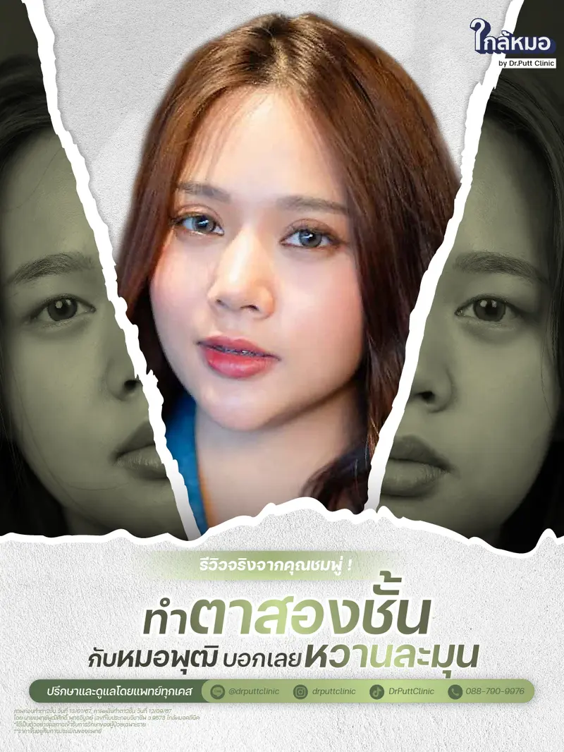 Double eyelid surgery