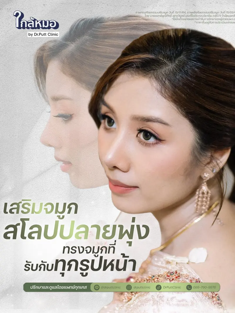 ศัลยกรรมจมูก