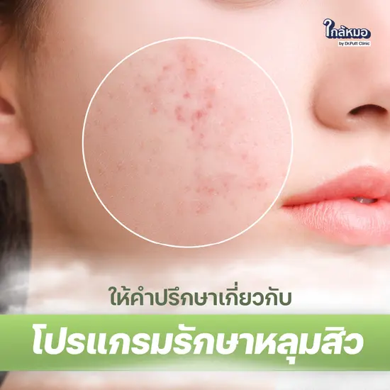 ให้คำปรึกษาเกี่ยวกับหัตถการโปรแกรมรักษาหลุมสิว