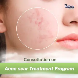 Acne Scar Treatment Consultation