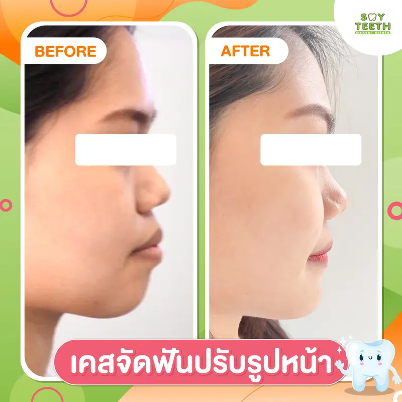 เคสจัดฟันปรับรูปหน้า
