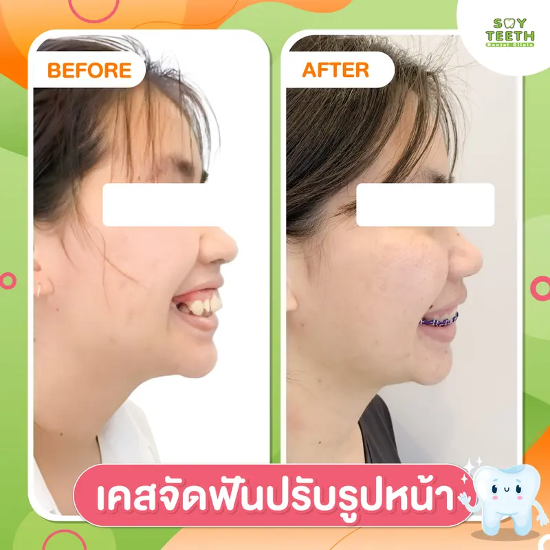 เคสจัดฟันปรับรูปหน้า