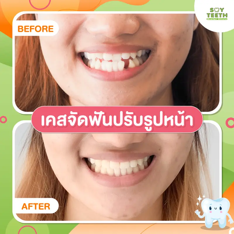 เคสจัดฟันปรับรูปหน้า