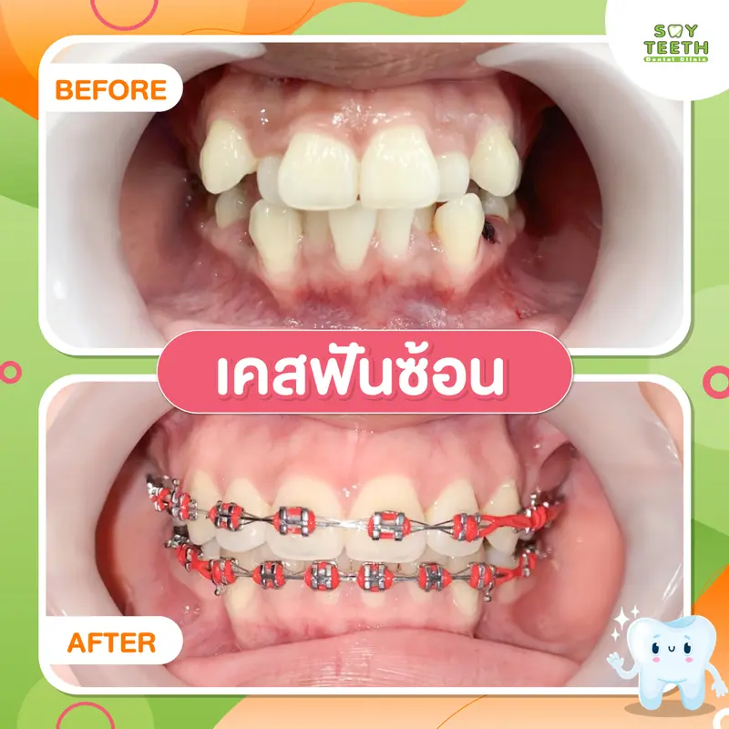 เคสฟันซ้อน