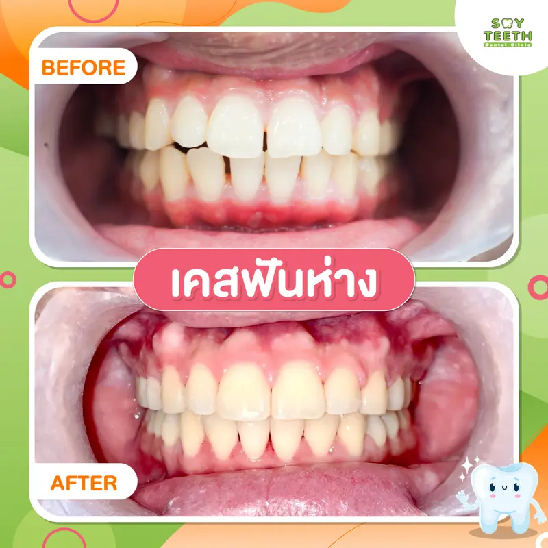 เคสฟันห่าง