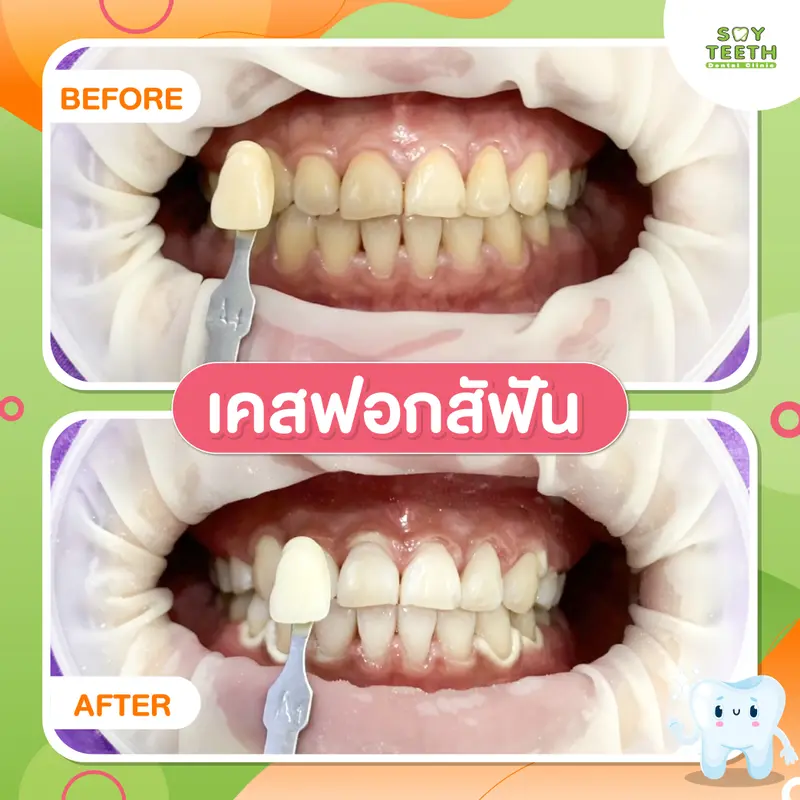 เคสฟอกสีฟัน