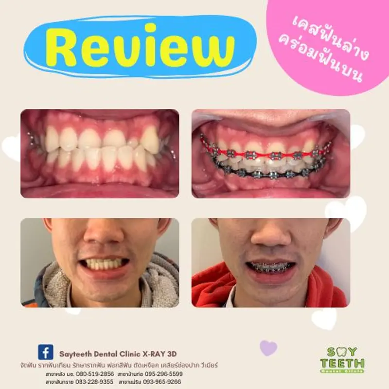 เคสฟันล่างคร่อมฟันบน