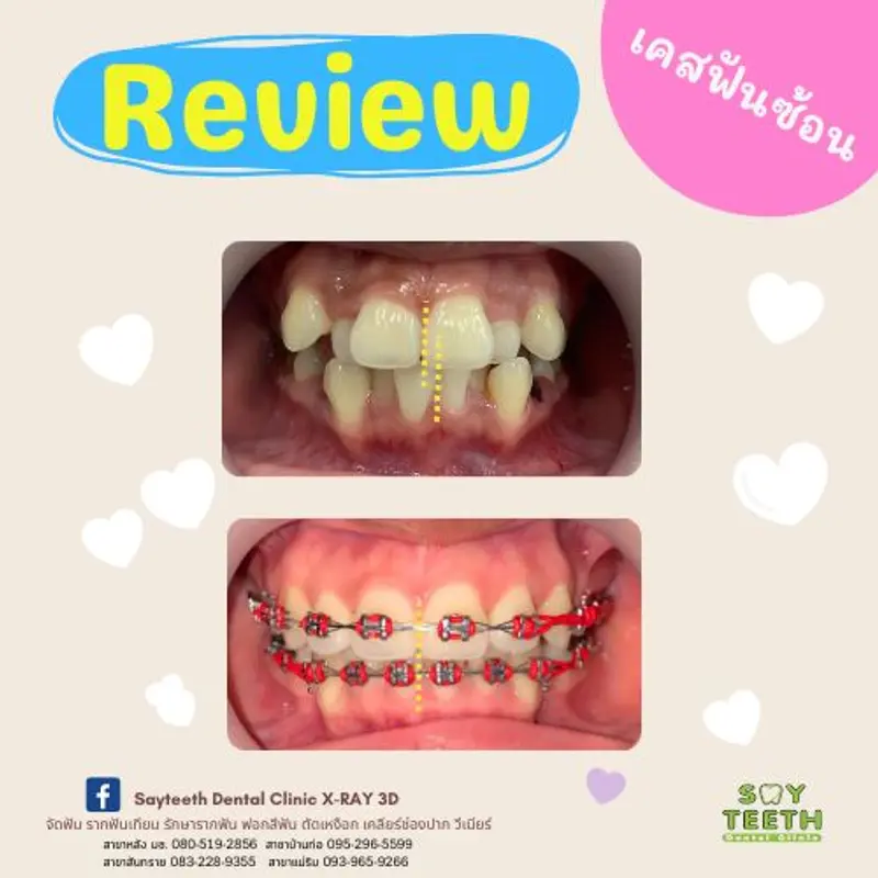 เคสฟันซ้อนเก