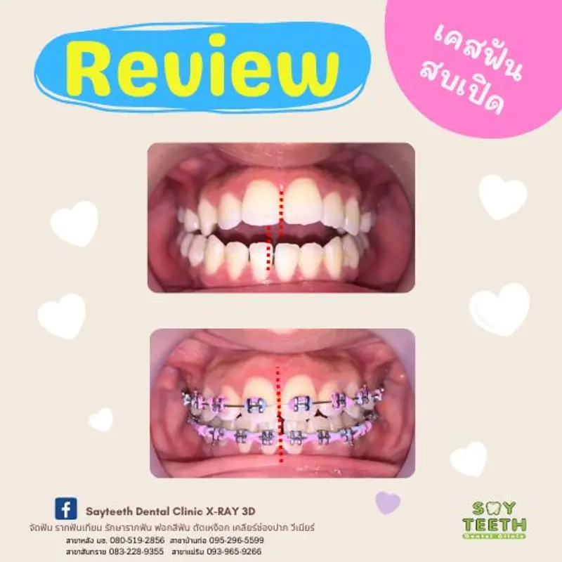 เคสฟันสบเปิด