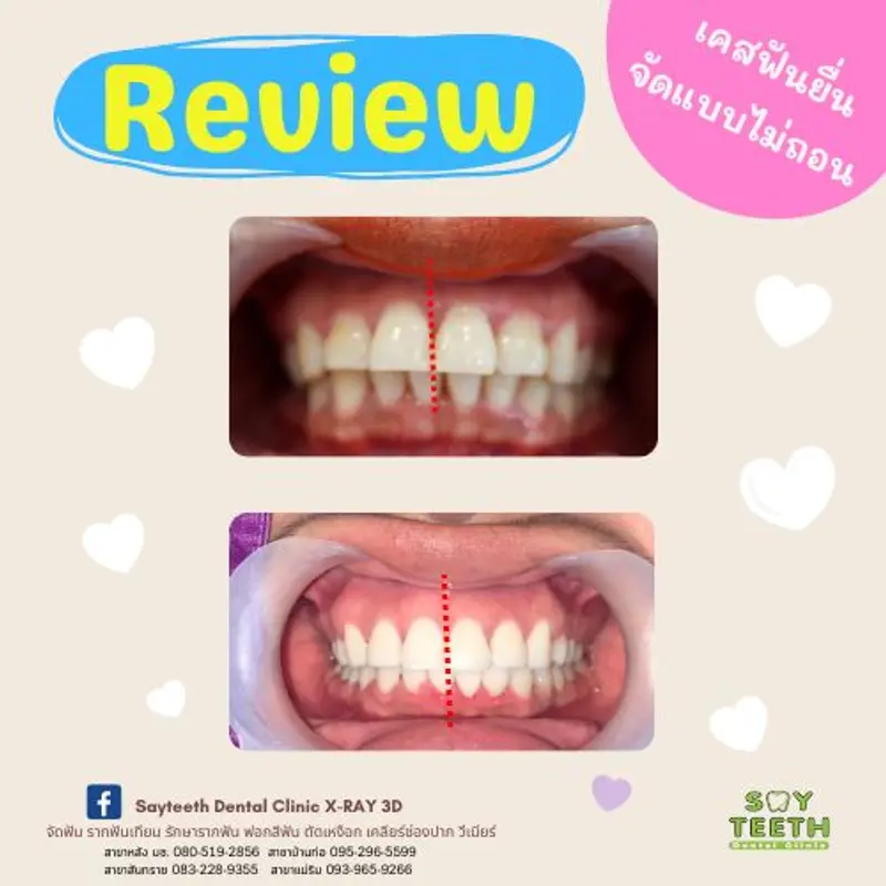 เคสฟันยื่น จัดฟันแบบไม่ถอน
