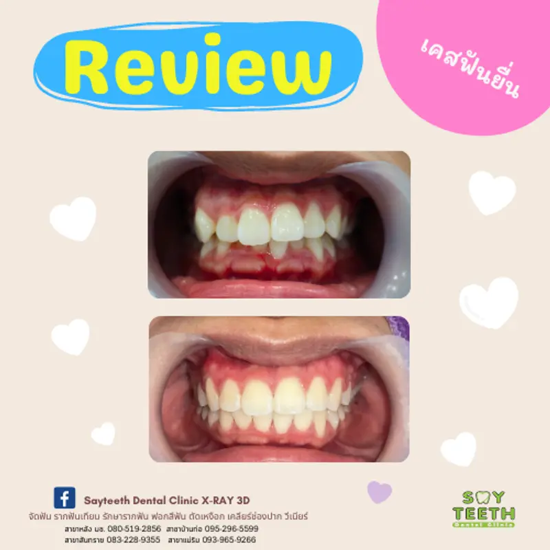 เคสฟันยื่น