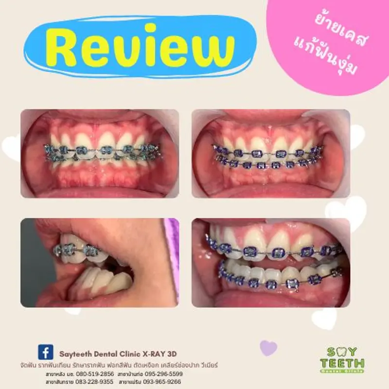 ย้ายเคสแก้ฟันงุ่ม