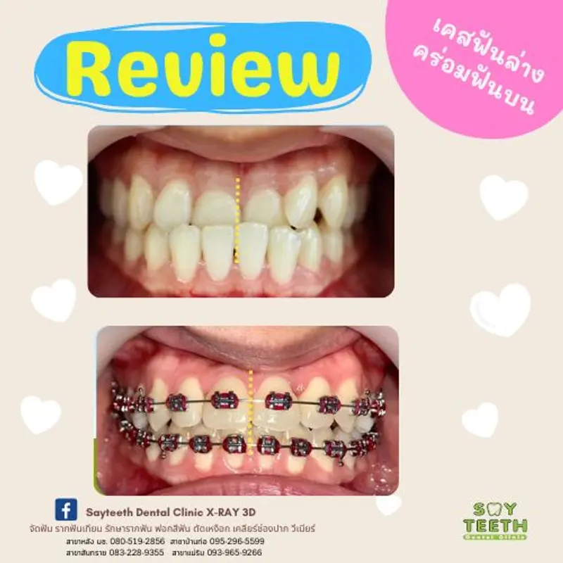 เคสฟันล่างคร่อมฟันบน