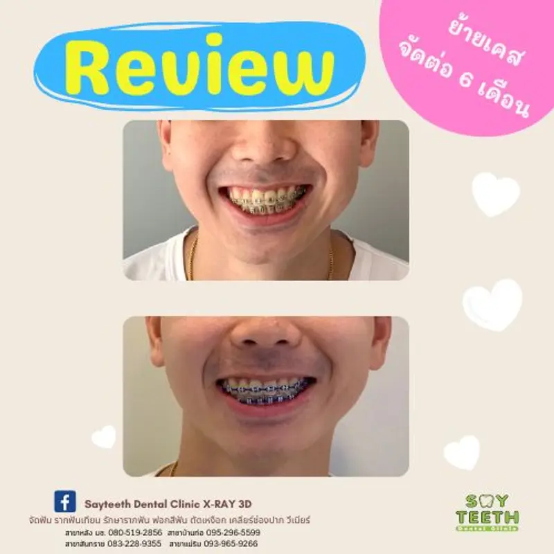 ย้ายเคสจัดต่อ