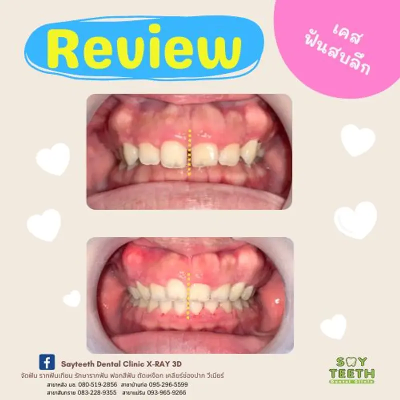 เคสฟันสบลึก