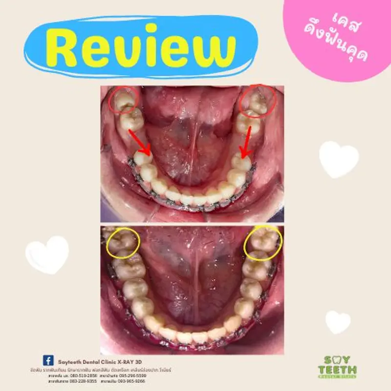 เคสดึงฟันคุด