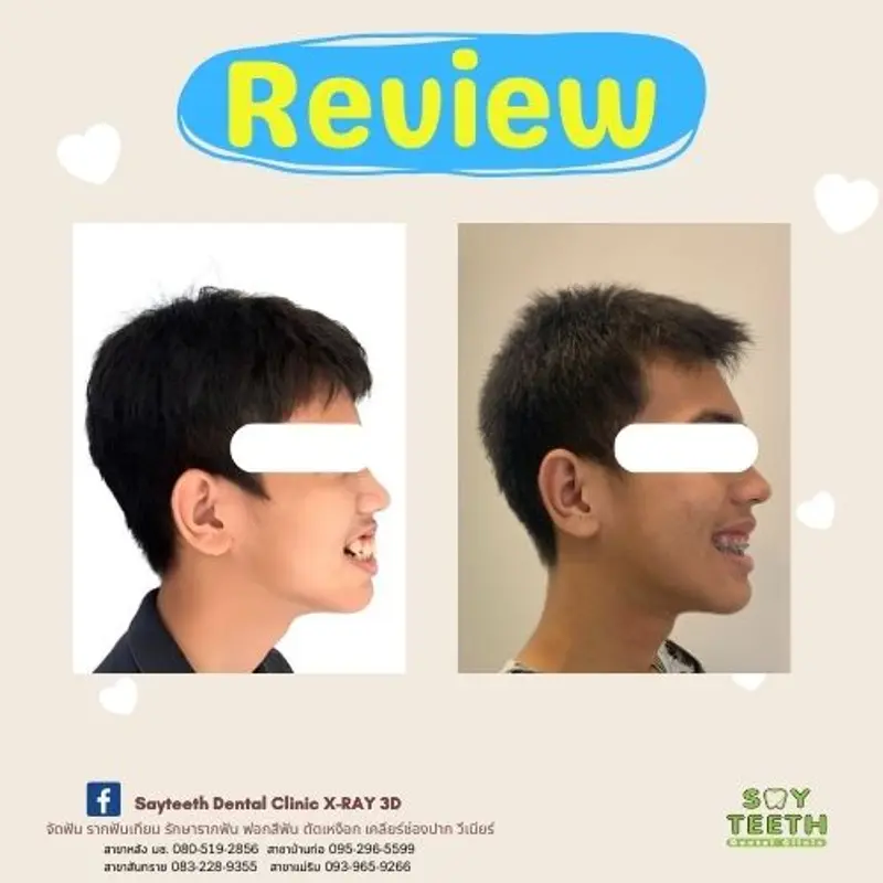 เคสจัดฟันปรับรูปหน้า