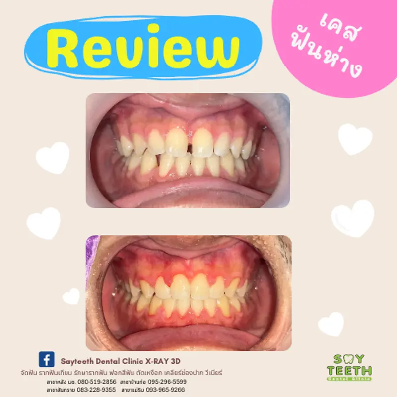 เคสฟันห่าง