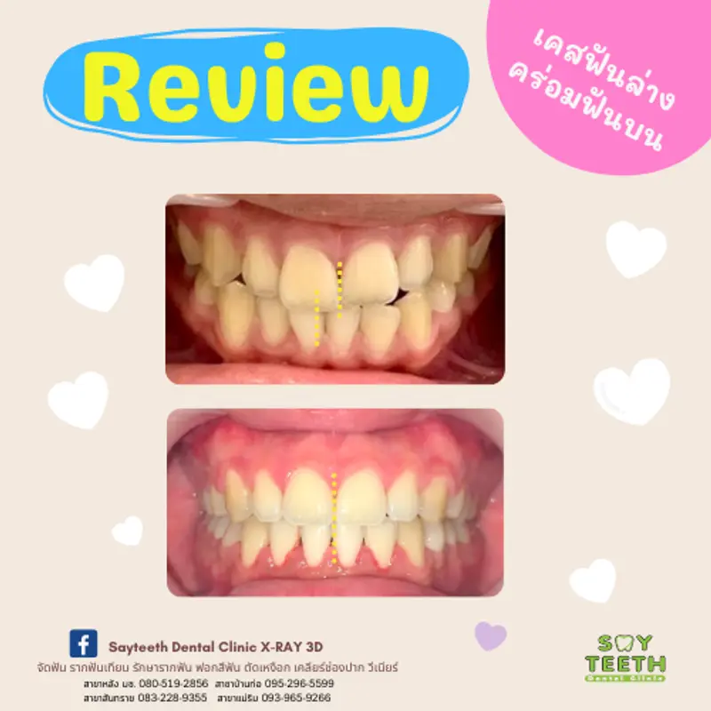 เคสฟันล่างคร่อมฟันบน