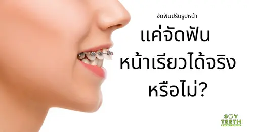 จัดฟันปรับรูปหน้า แค่จัดฟัน หน้าเรียวได้จริงหรือไม่?